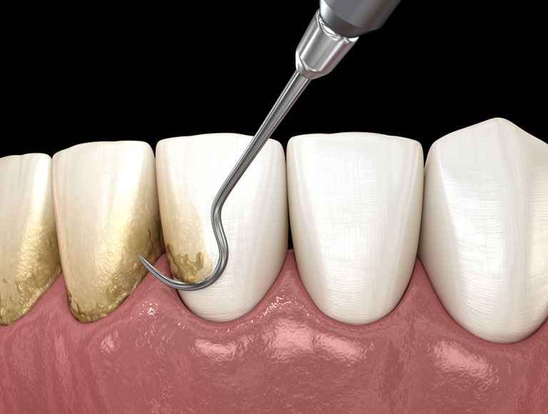 Periodontal Treatment