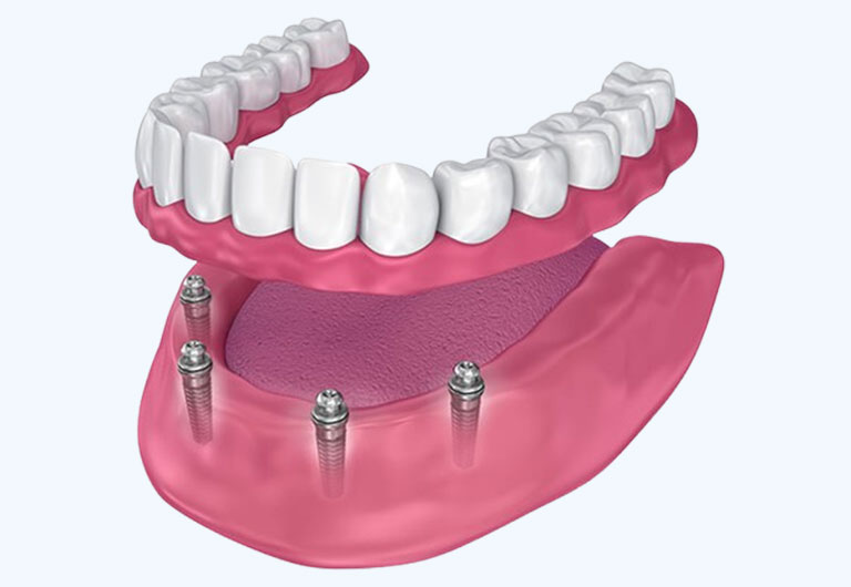Benefits of All-On-X®