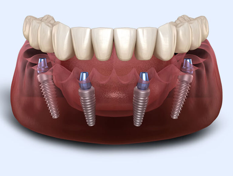 The All-On-X® Technique
