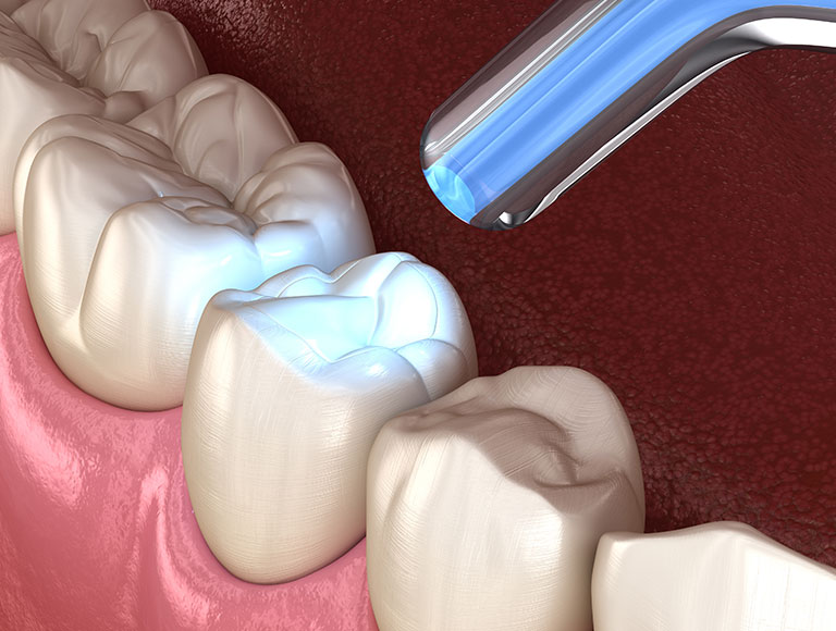 Dental Fillings