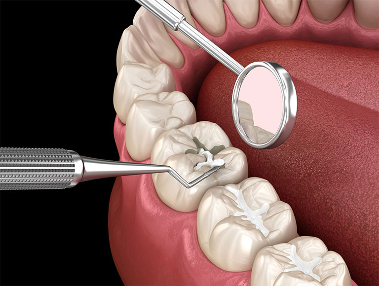 Dental Sealants
