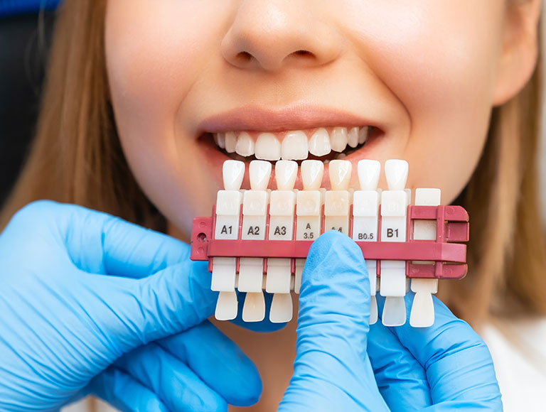 Veneers