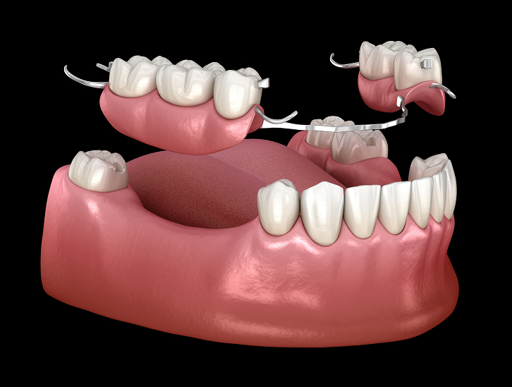 Partials & Dentures