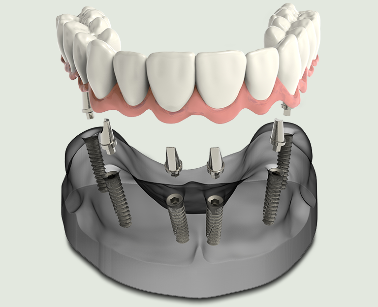 Tailored Implant Solutions