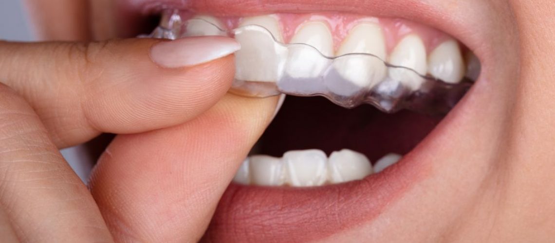 The Best Time For Invisalign Treatment